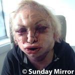 WARNING GRAPHIC CONTENT: Former Boxing Promoter Kellie Maloney Lucky To Be Alive After Cosmetic Surgery 