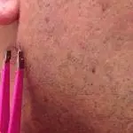 LOOK: This Guy Shaves Off Beard To Find The Most Insane Ingrown Hair Of All Time