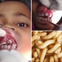 15 Live Maggots Removed From Girl’s Gums